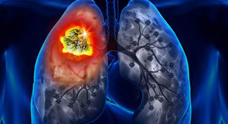 رئيس الجمعية التونسية لمكافحة سرطان الرئة لـ«الصباح»:   تونس تسجّل 6 آلاف حالة جديدة بسرطان الرئة سنويا..